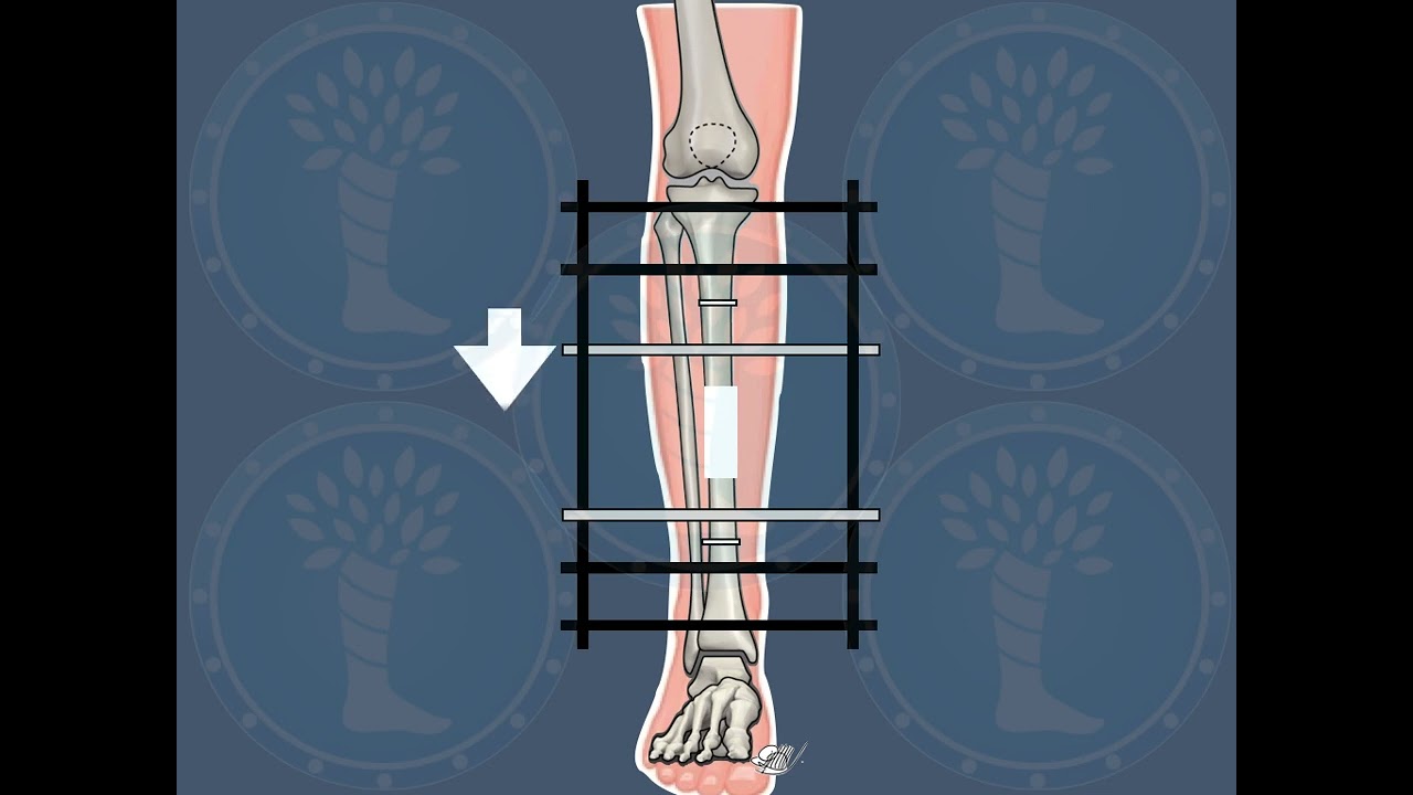 Transporte &oacute;seo Fijaci&oacute;n externa circular