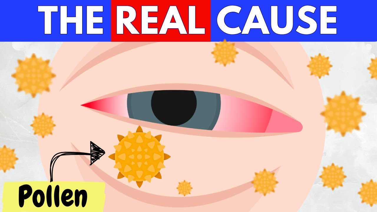 Eye Allergies Simply Explained