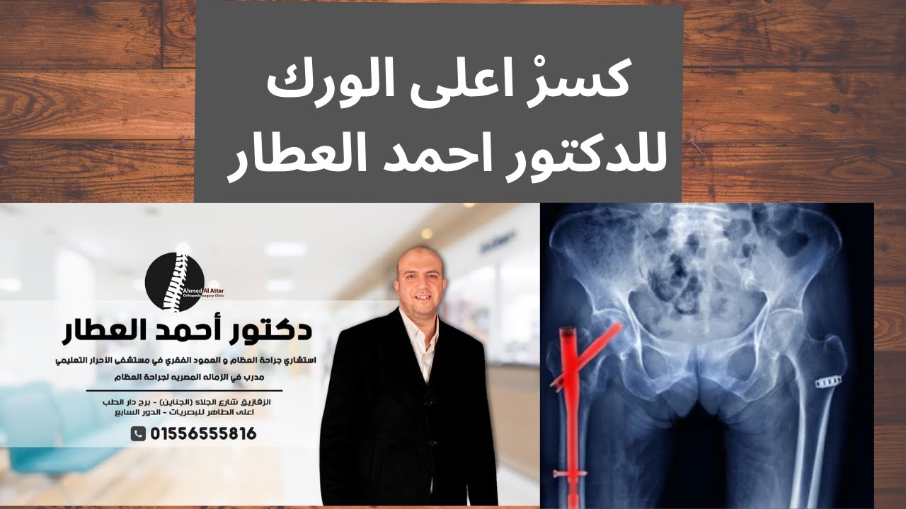 كسرْ اعلى الورك للدكتور احمد العطار