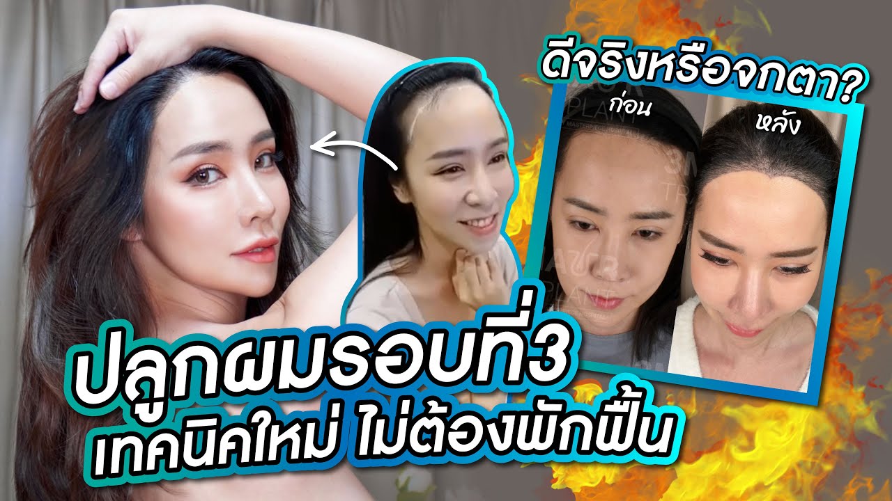 ปลูกผมรอบที่3 ไม่ต้องพักฟื้น ดีจริงหรือจกตา? เทคนิคใหม่ล่าสุด FUE&DHI