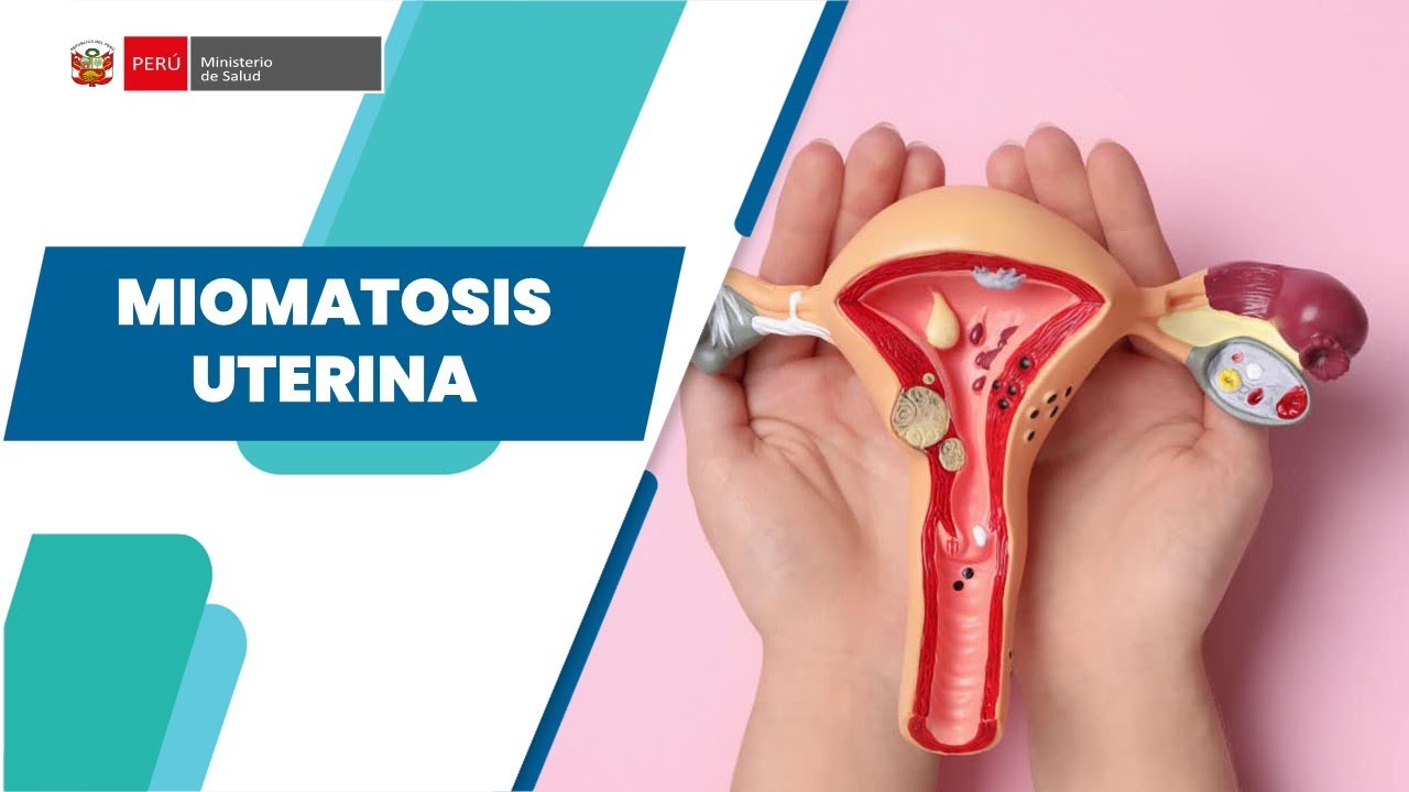 MIOMATOSIS UTERINA