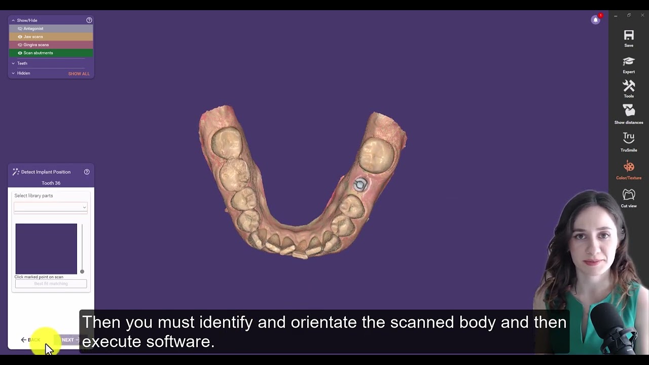 5  Helios 500 Implant Workflow in Exocad