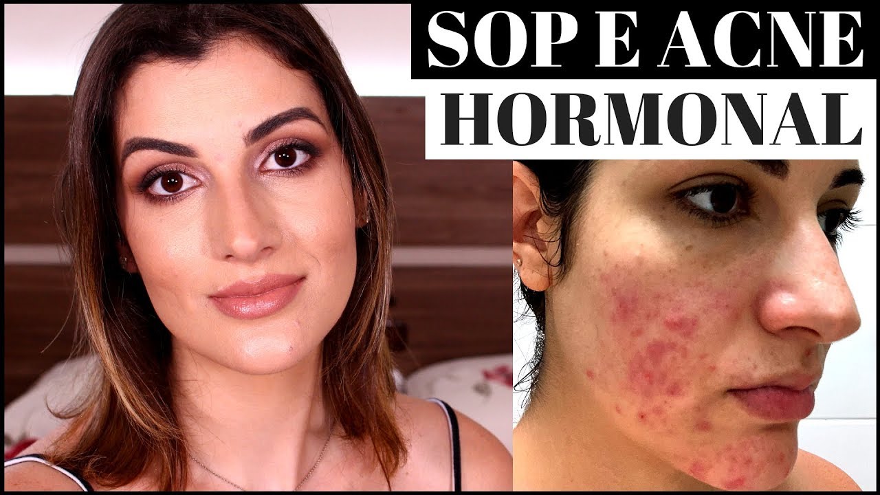 MEU TRATAMENTO PARA ACNE HORMONAL CAUSADA POR SOP | MAY DANCINI