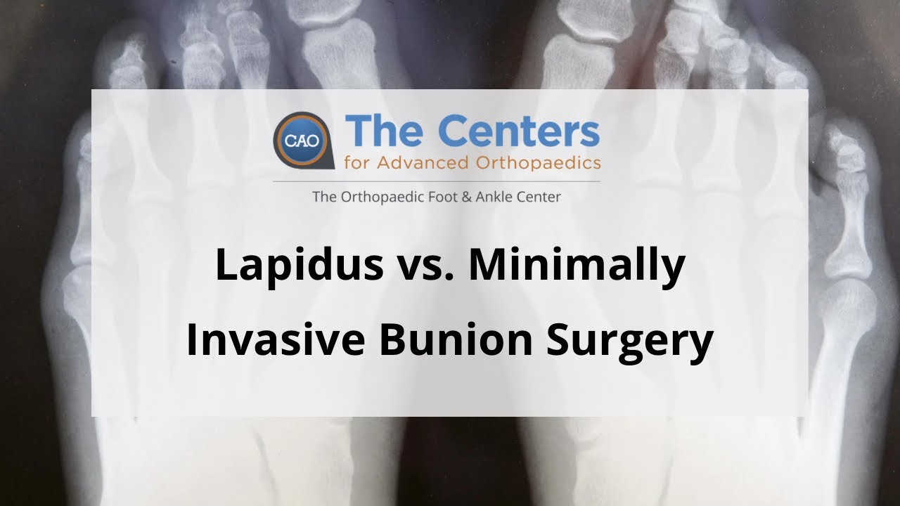 Lapidus vs. Minimally Invasive Bunion Surgery