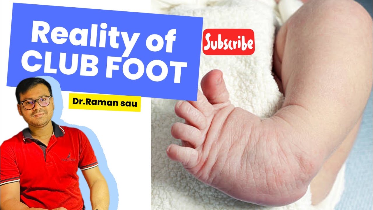 How bad is Club foot ? || Club foot in ANOMALY SCAN
