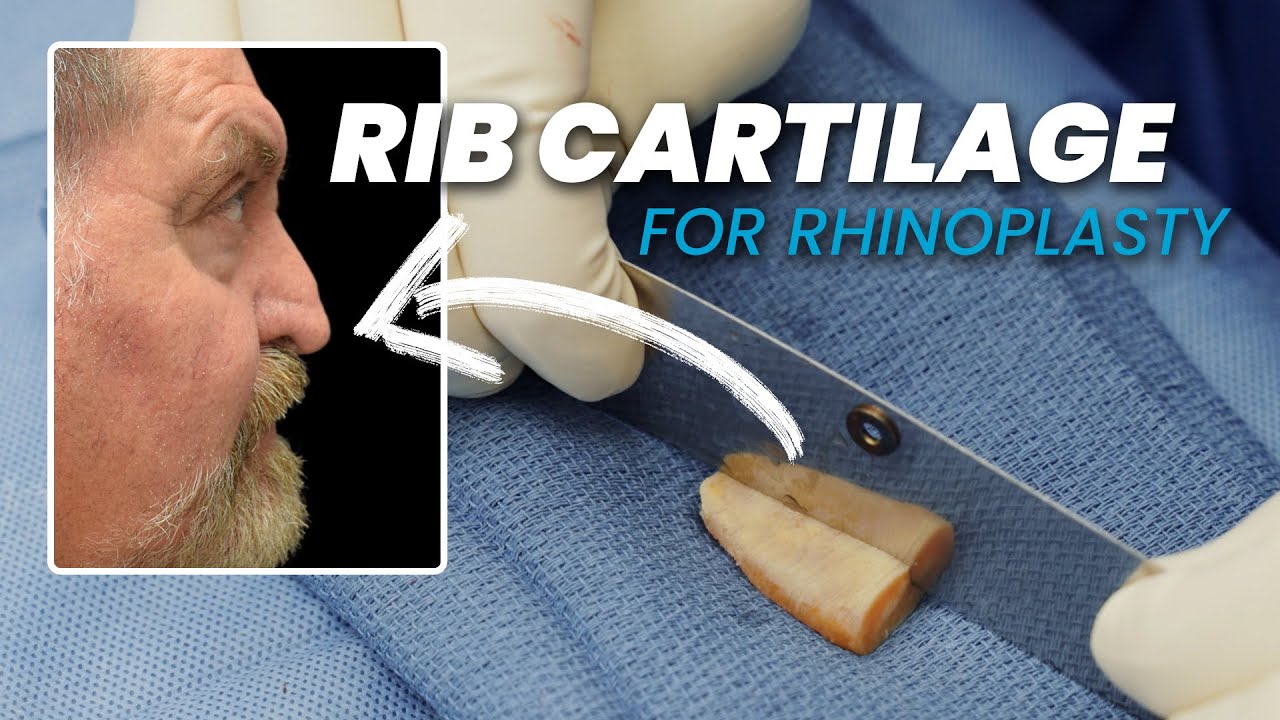 Rib Allograft in Rhinoplasty: How the Technique Enhances Your Nose Surgery