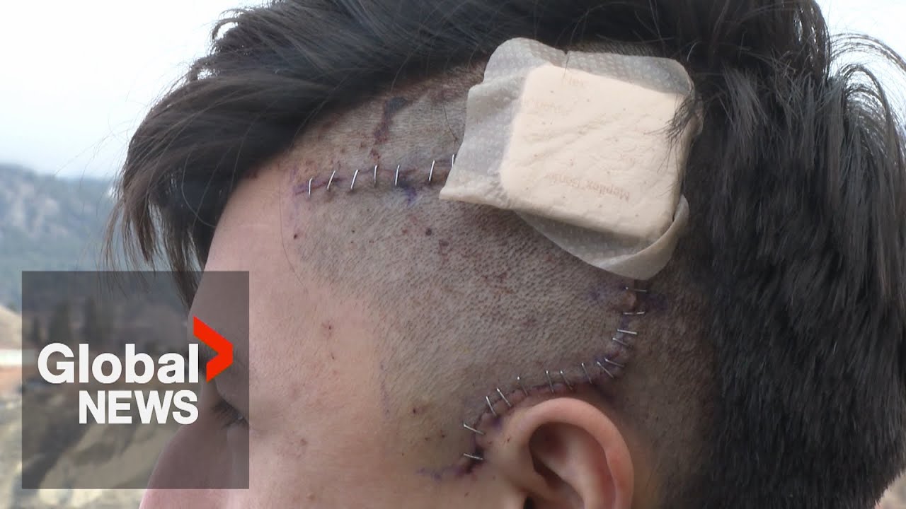 BC family outraged after suspect involved in violent attack on their son walks free