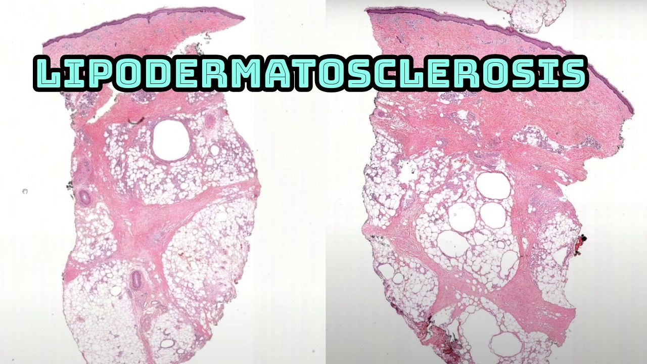 Lipodermatosclerosis (hard firm dark brown red thick skin lower legs from venous stasis) pathology