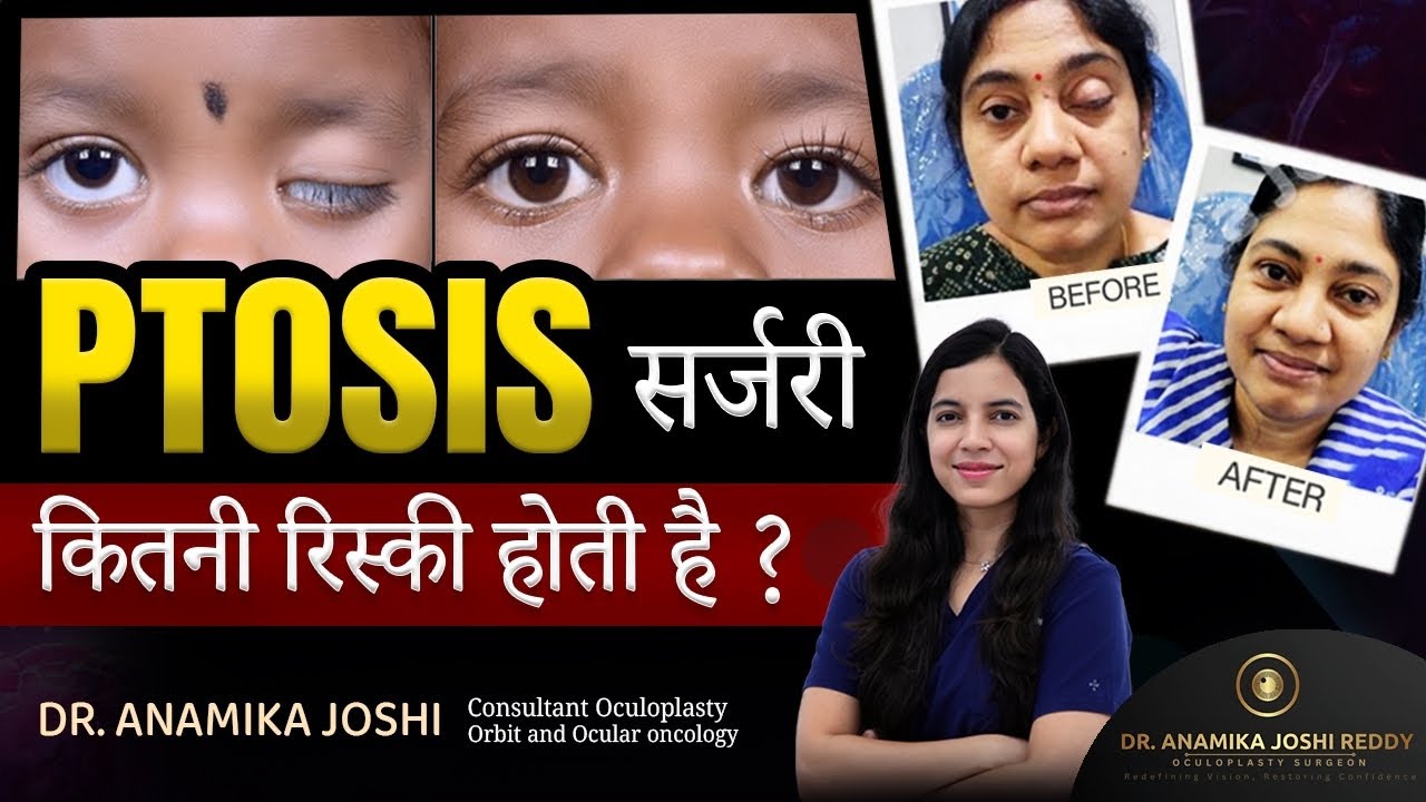Ptosis सर्जरी कितनी रिस्की होती है | ptosis surgery in hindi | Dr Anamika Joshi