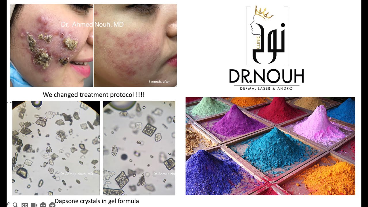 Topical Dapsone gel: a review of its efficacy and safety