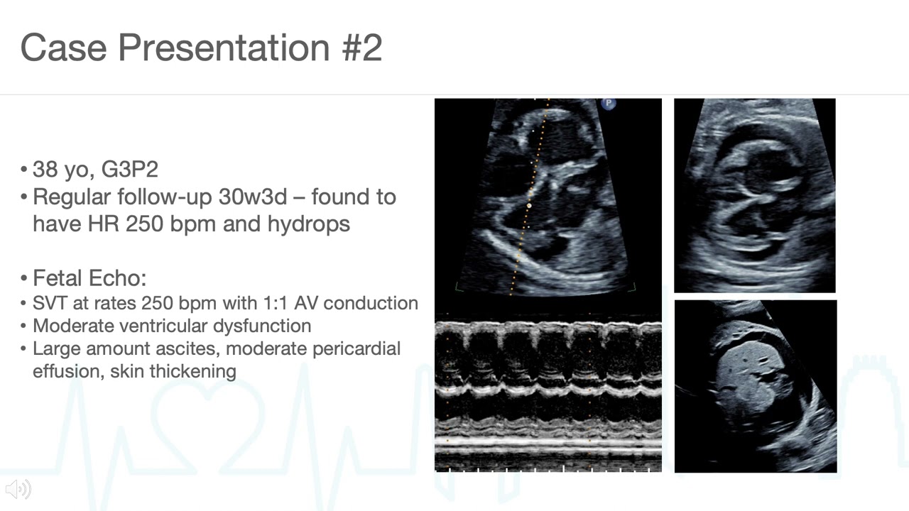 Update on Fetal Therapy for SVT