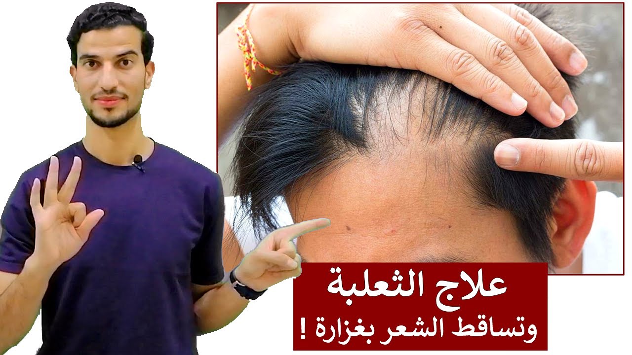 3 طرق طبيعية للتخلص نهائيا من الثعلبة وتساقط الشعر الشديد ( وصفة تُعيد انبات الشعر )
