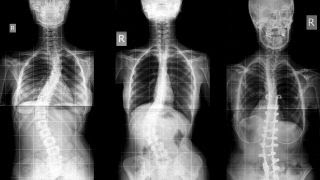Could you develop adult scoliosis?