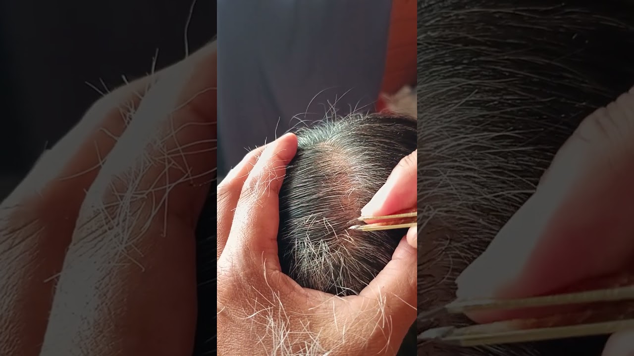 Mostly satisfying white hair removal 1.13#satisfying #relaxing #stressremoval