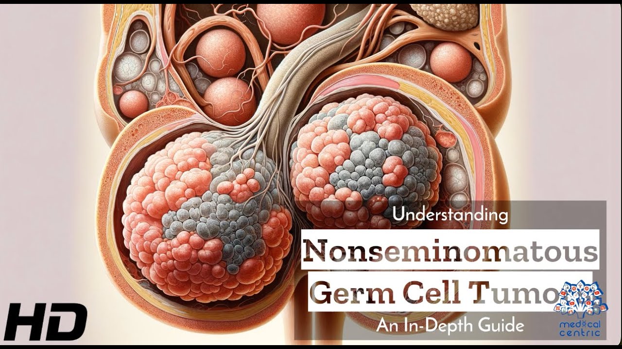 Nonseminomatous Germ Cell Tumors Explained: What You Need to Know