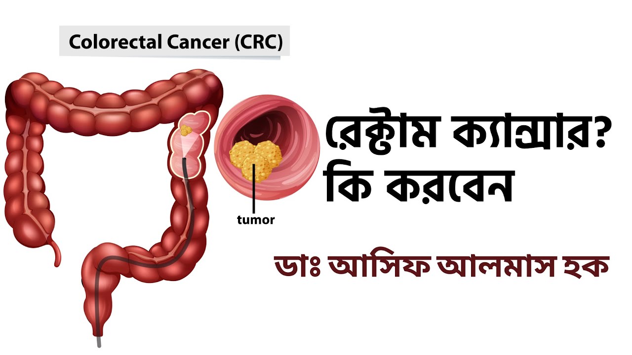 রেক্টাম ক্যান্সার? কি করবেন। Rectal cancer? what to do