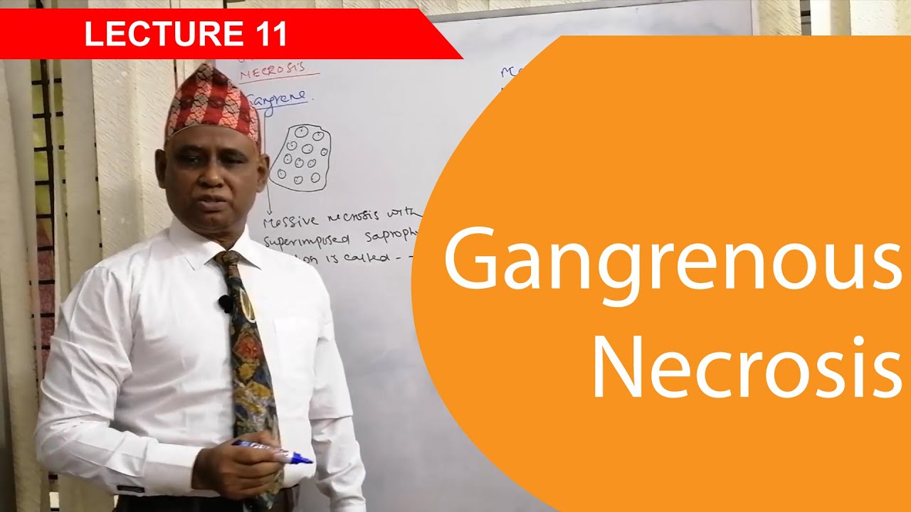General Pathology: Lecture 11 | Gangrenous Necrosis