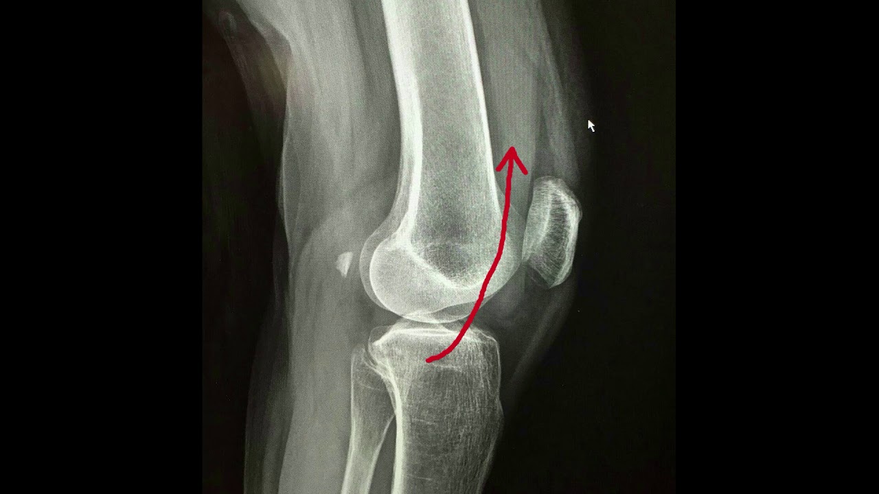Tibial Plateau Fracture Orange County CA | Knee Lipohemearthrosis Relief