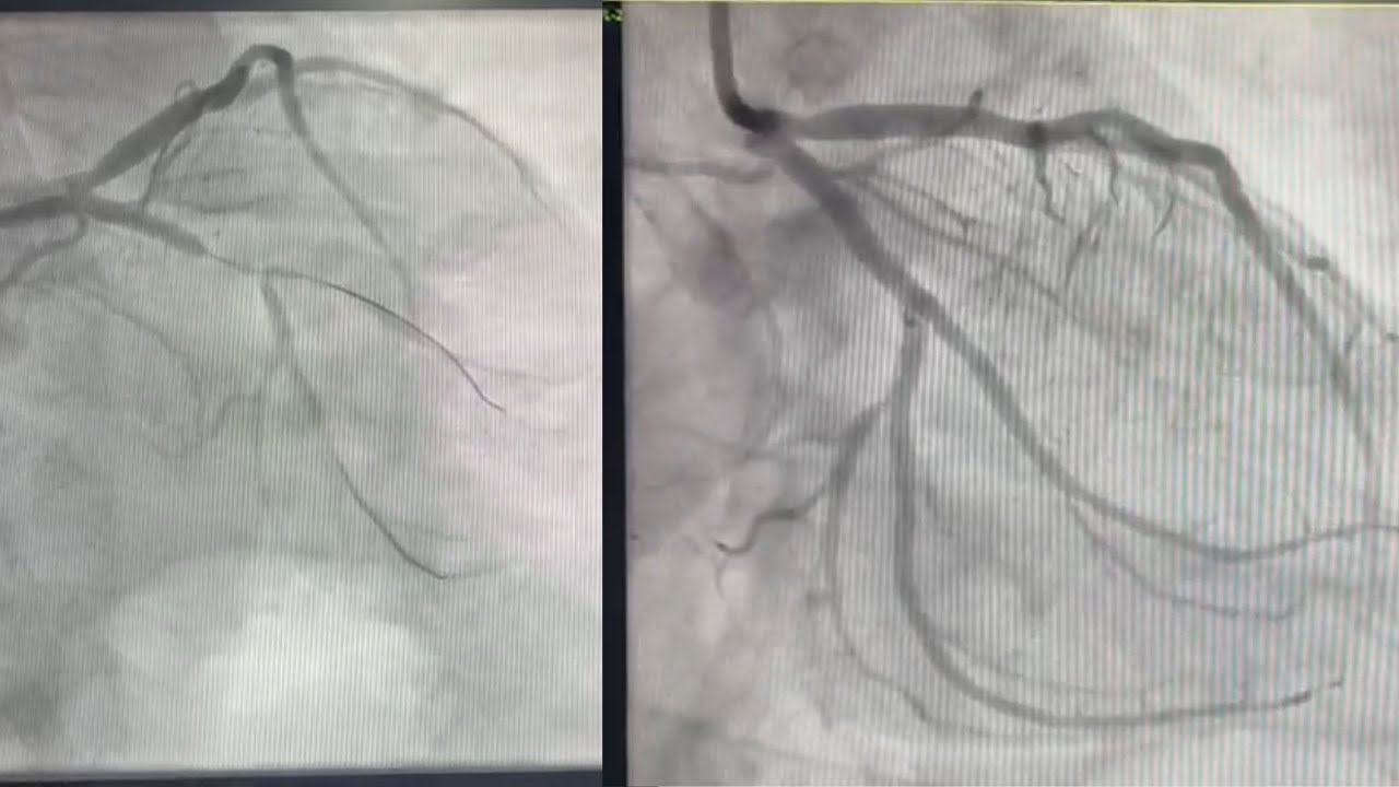 Culotte Bifurcation stenting in LCx-OM bifurcation - Dr Md Faizuddin