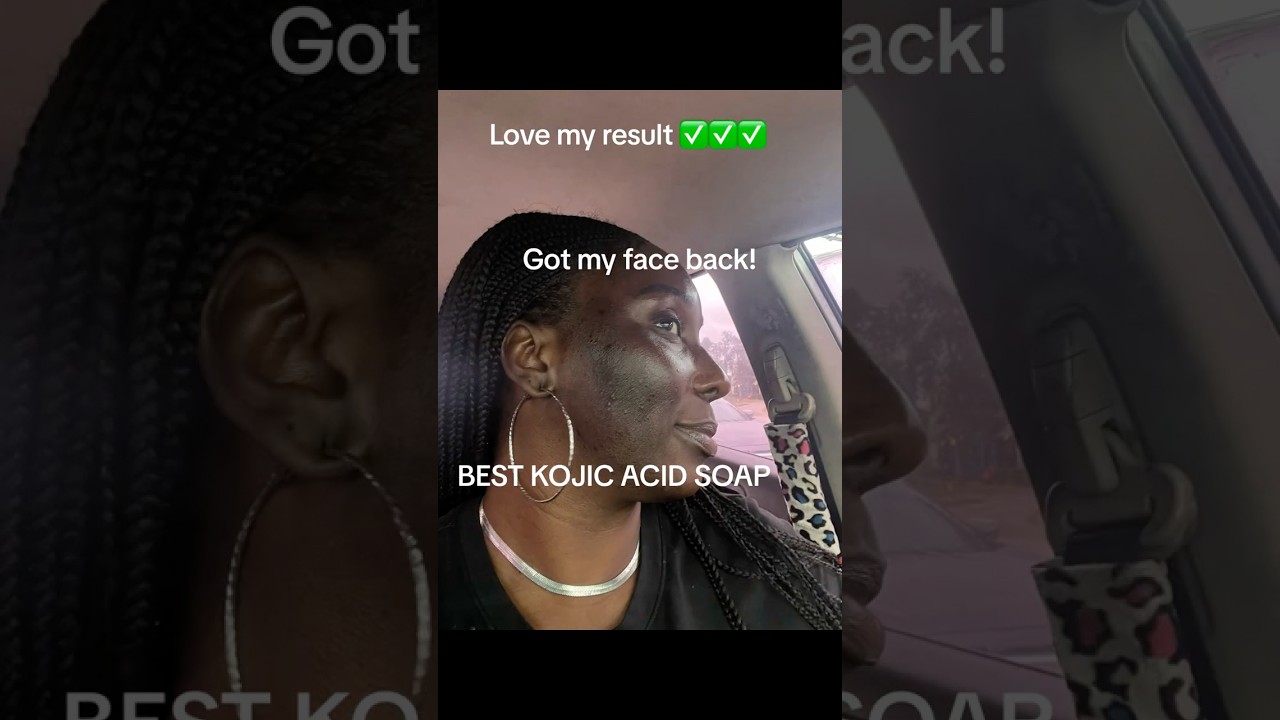BEST KOJIC ACID SOAP, I got my face back, love the results❤️
