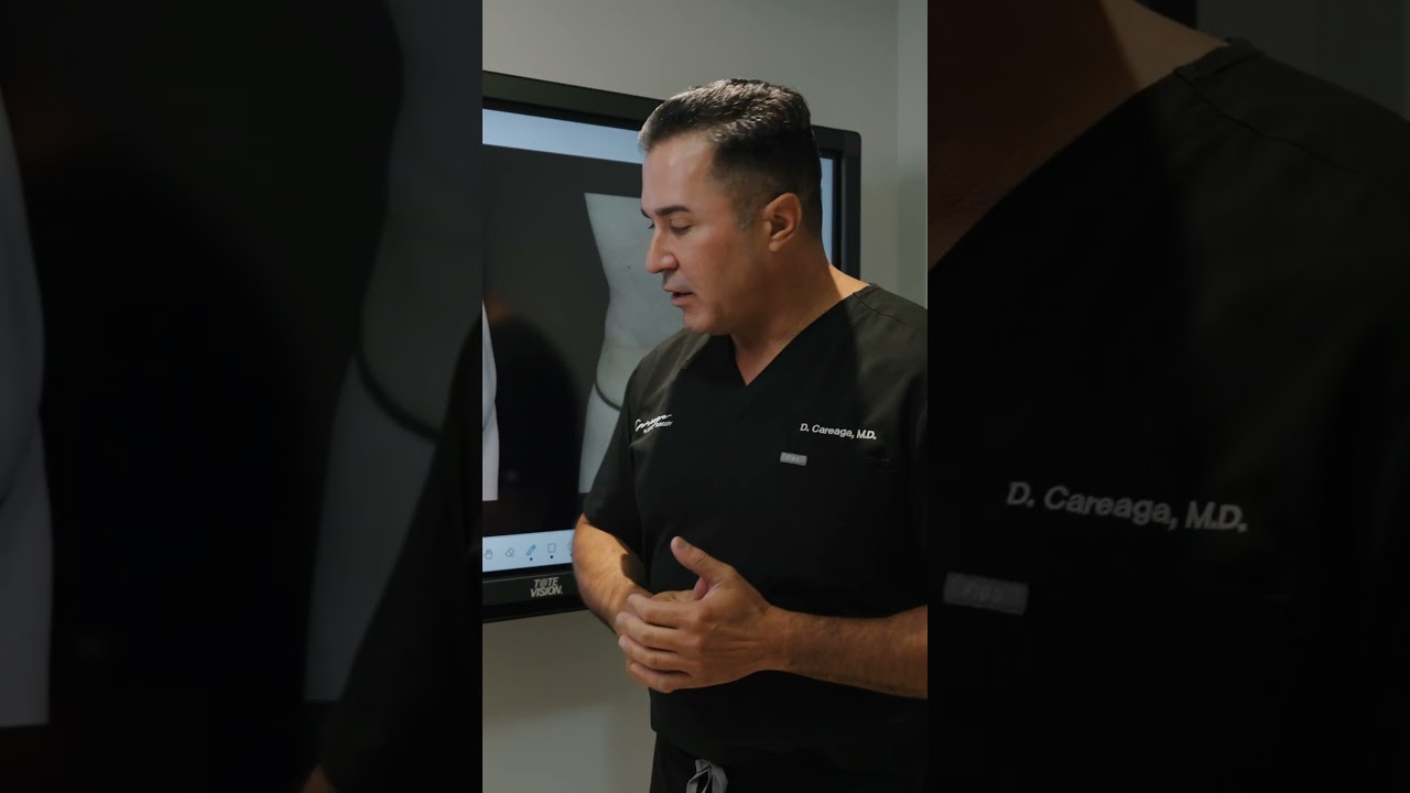Incisi&oacute;n Vertical en la Abdominoplastia  #careagaplasticsurgery