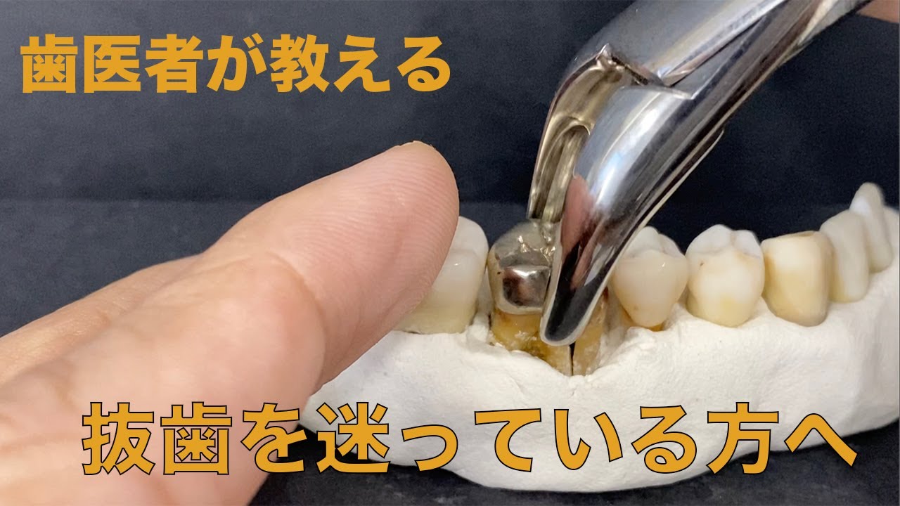 抜歯をおすすめする場合