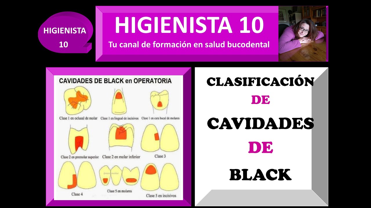 CLASIFICACIÓN DE CAVIDADES DE BLACK. TEMARIO GENERAL 19.