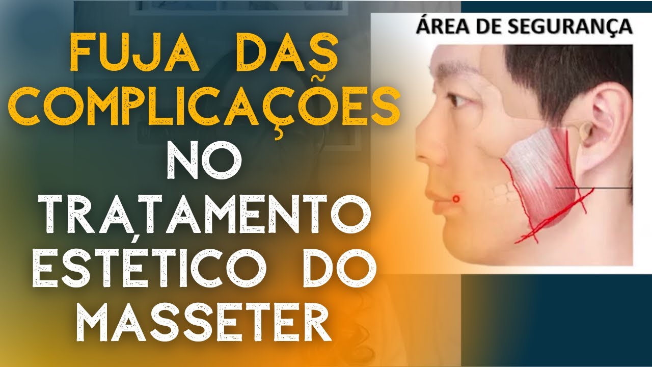 Fuja das complicações no tratamento estético do Masseter