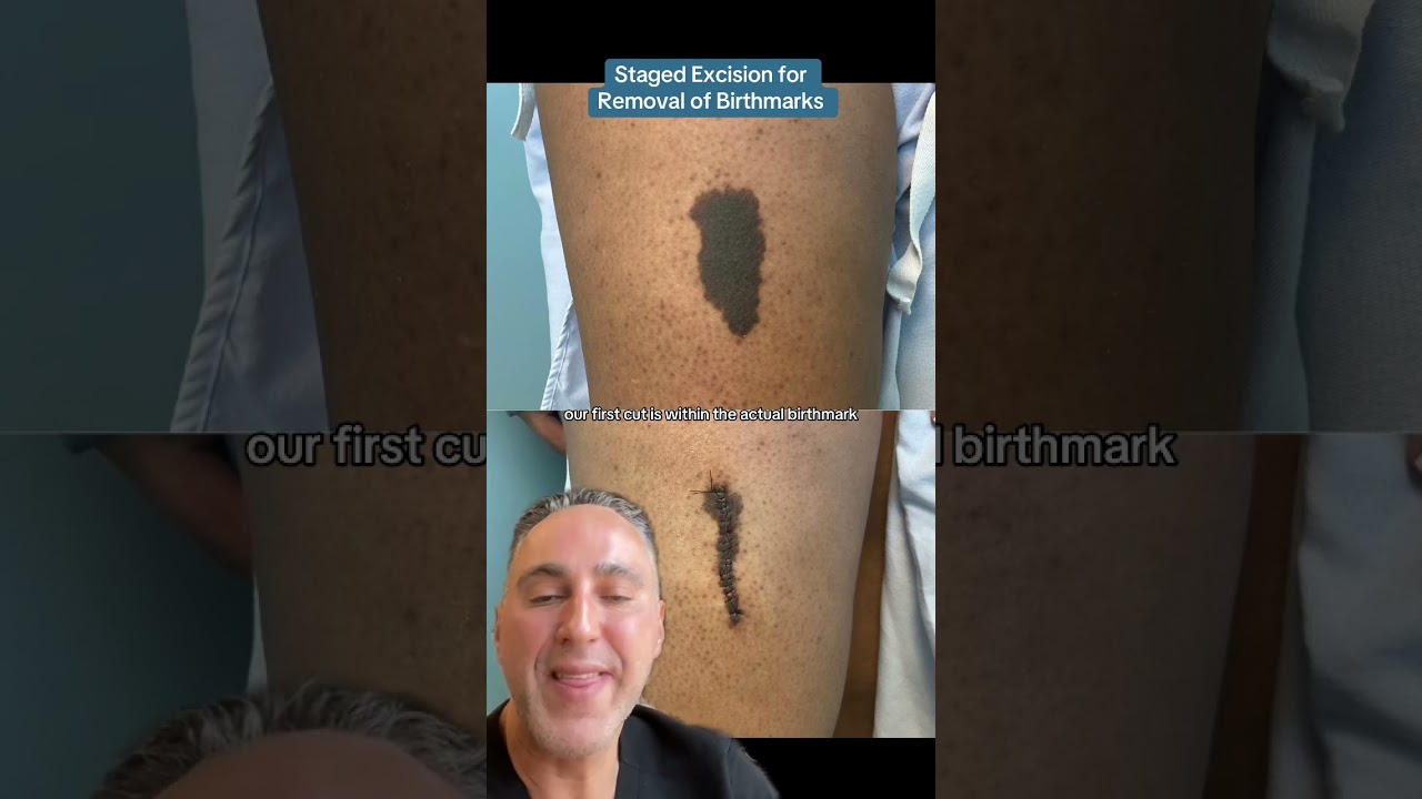 Staged Excision for Removal of Birthmarks