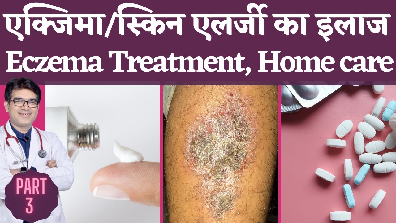 Eczema Treatment In Hindi | एक्ज़ेमा का इलाज | Skin Allergy, Dermatitis Treatment | Dermatologist