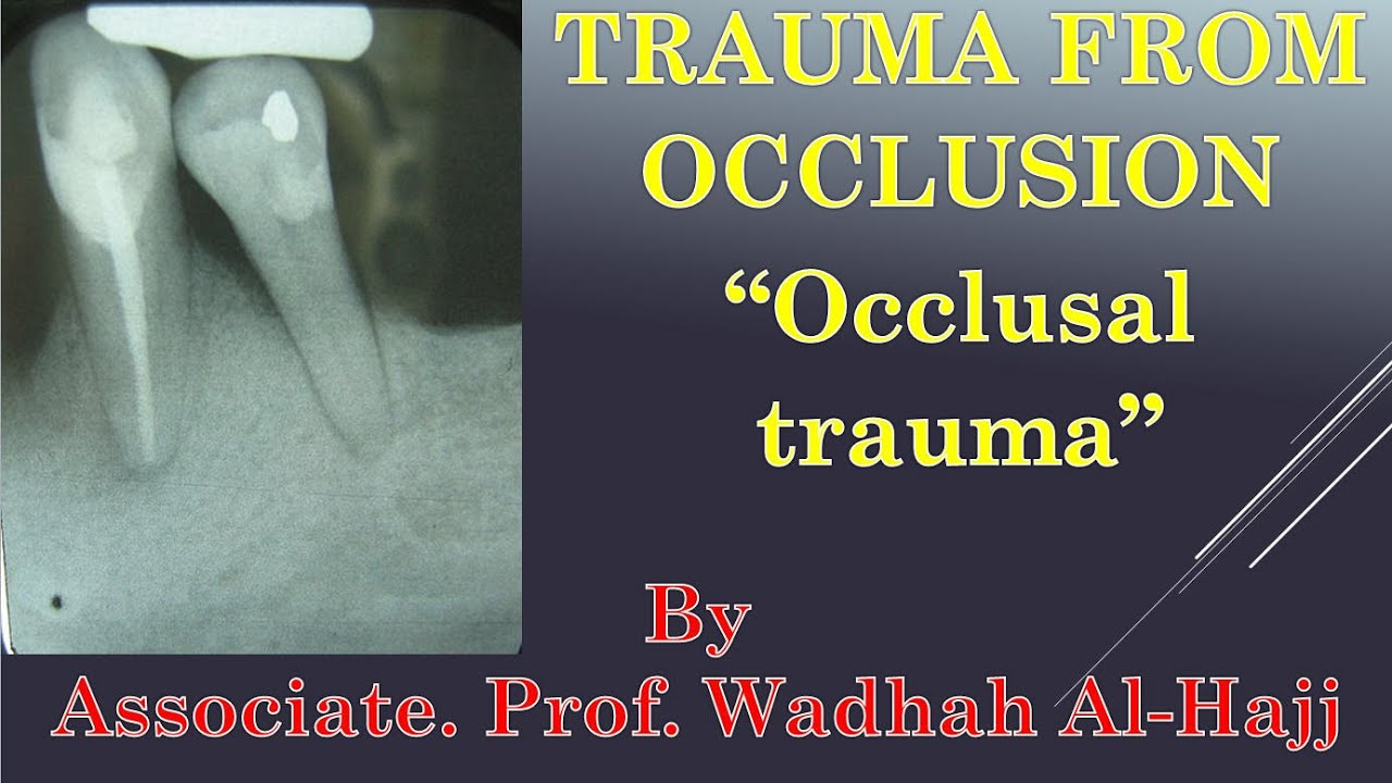 53- Trauma from occlusion ‫‬- Dr Wadhah Periodontology lectures.د/ وضاح الحاج‬‬‬‬‬‬‬‬‬‬‬‬‬‬‬‬‬‬‬‬‬