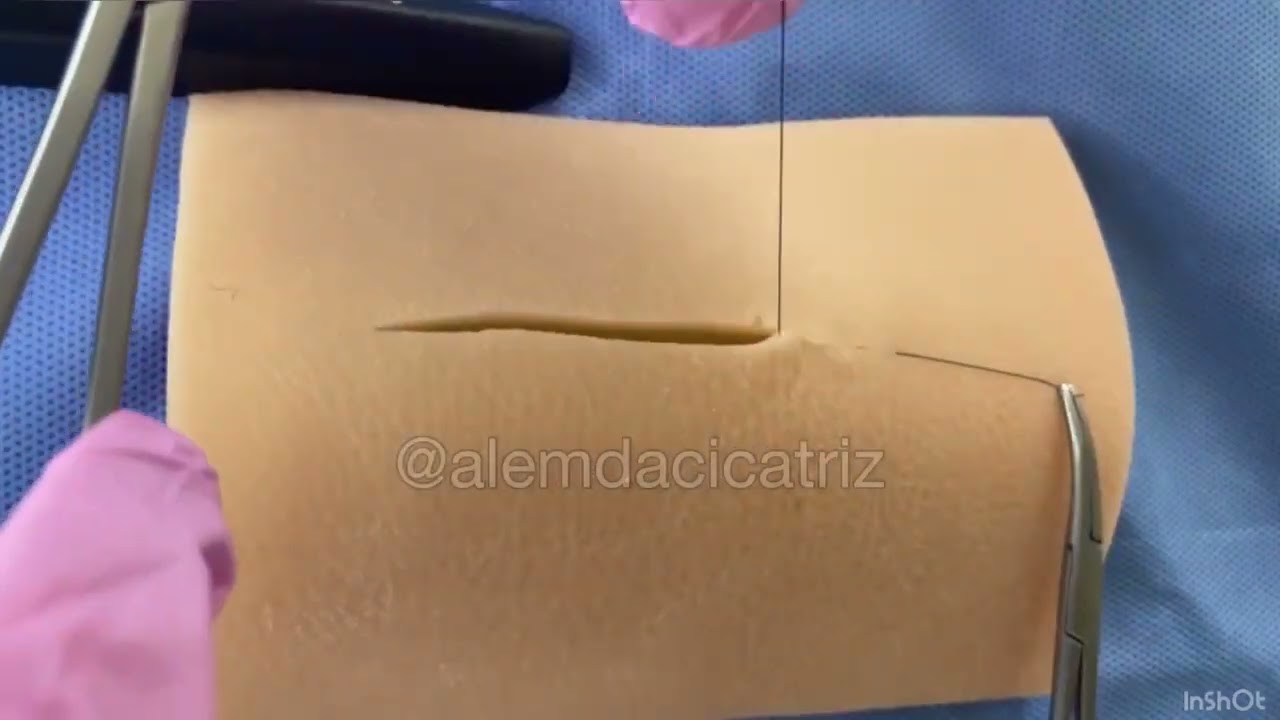 Ponto intradérmico