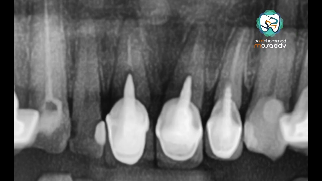 ازالة وتد معدني و كروان pfm    Remove metal post