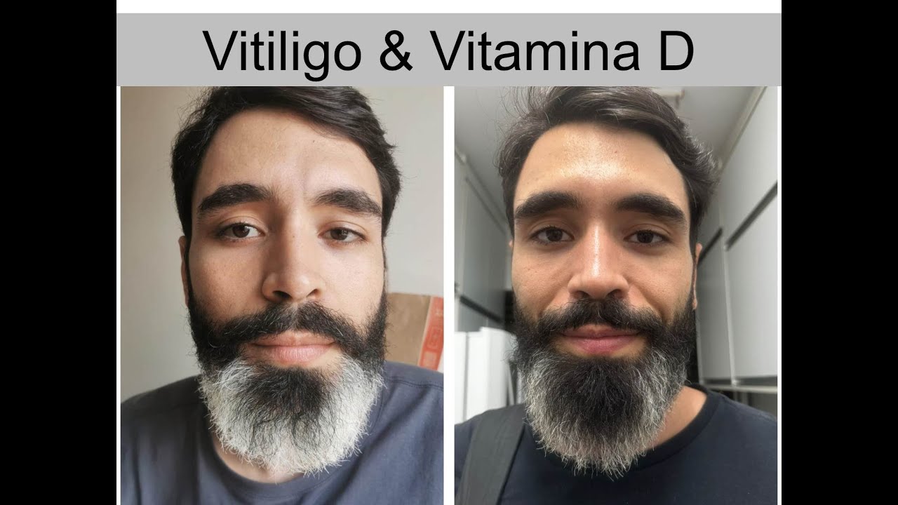 Arthur - Vitiligo #982