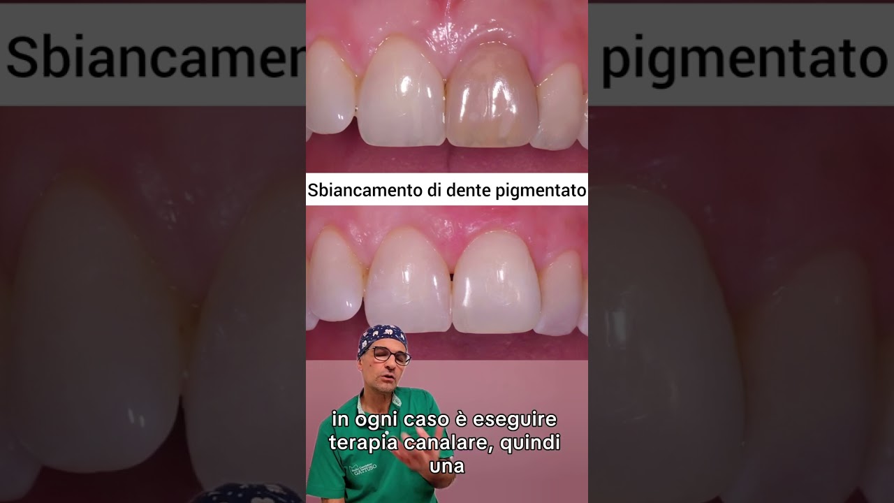 Sbiancamento Interno di Denti Pigmentati