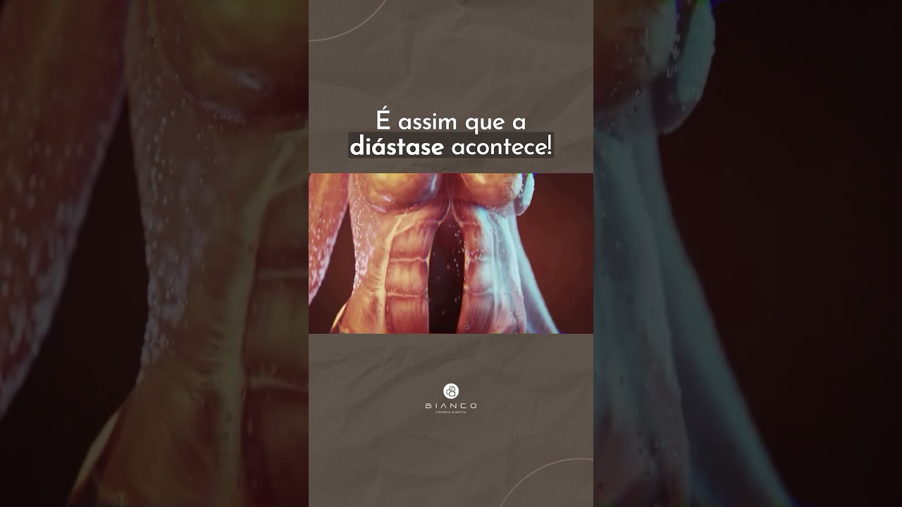 &Eacute; assim que acontece a di&aacute;stase abdominal! 🫣