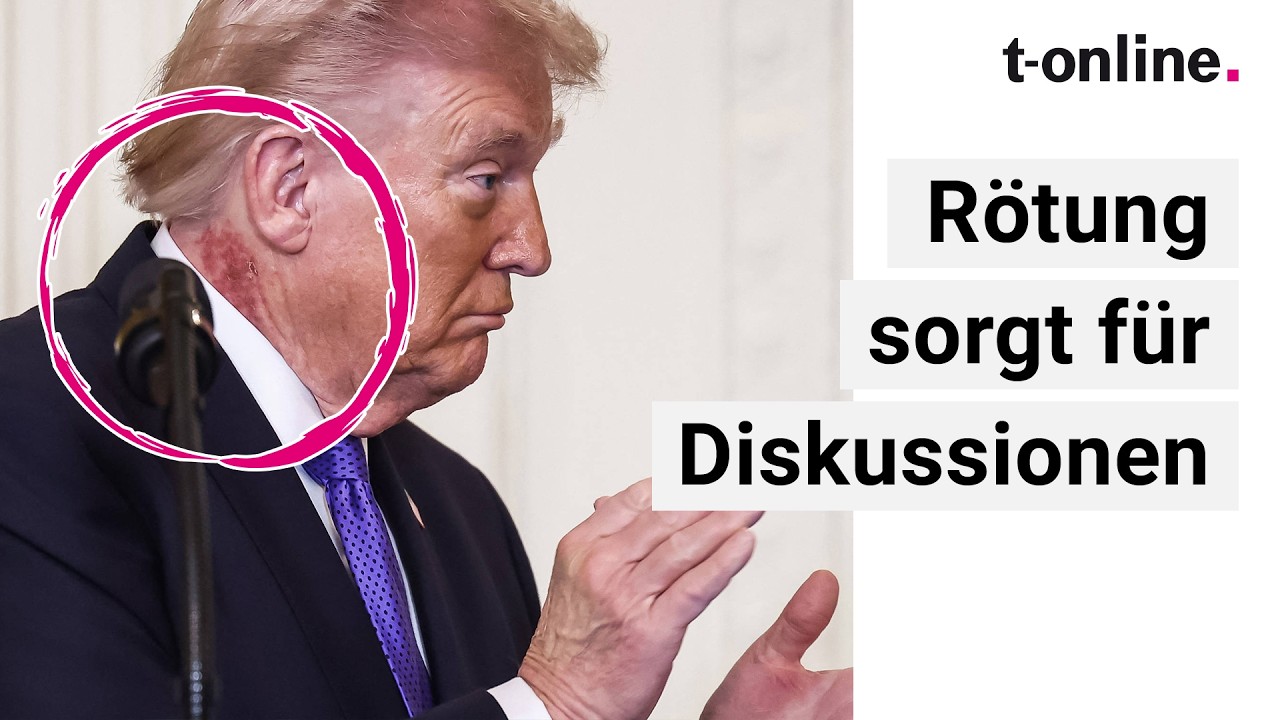 Donald Trump: Rote Flecken am Hals – Neue Spekulationen über Gesundheit