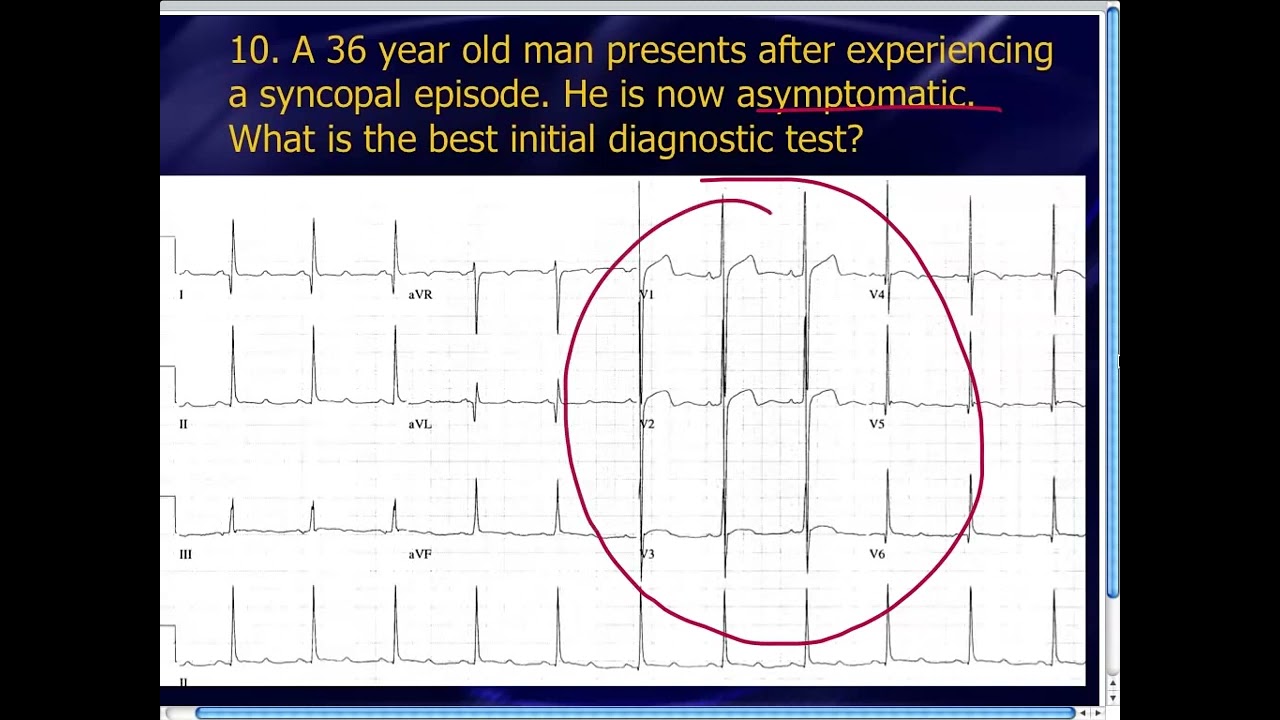 Amal Mattu's ECG Case of the Week_ May 26, 2014