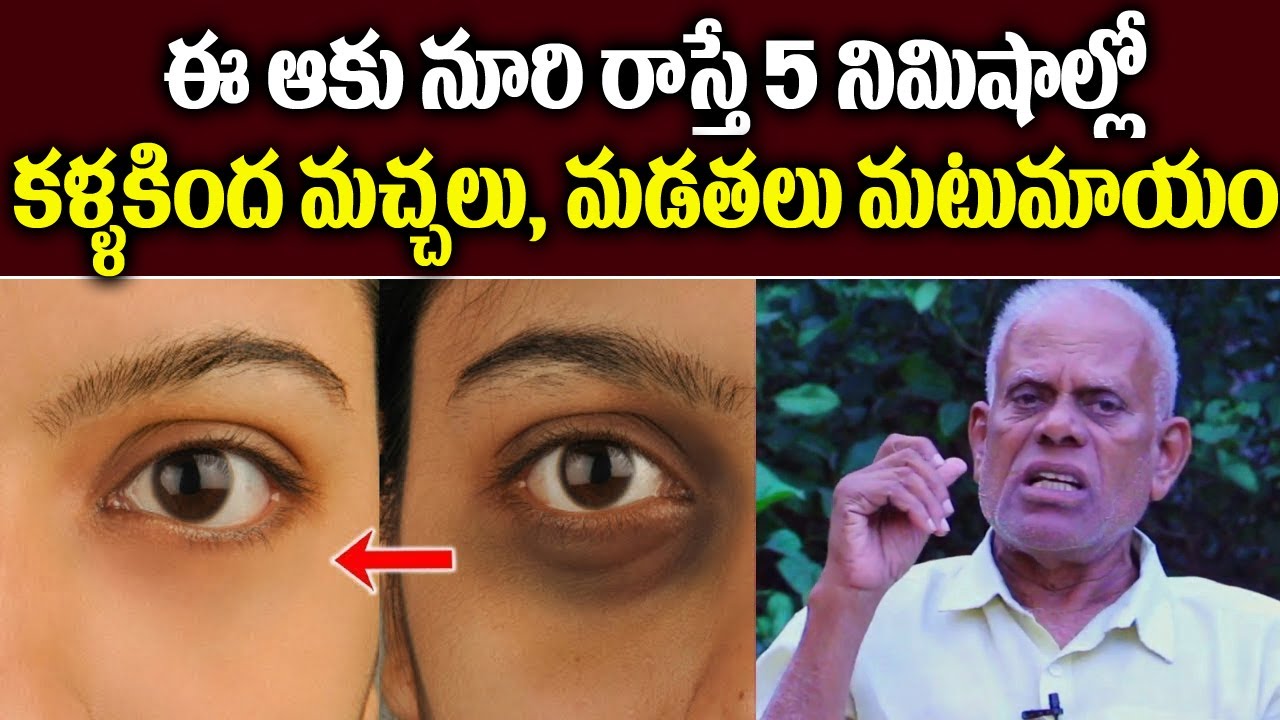 ఈ ఆకు నూరి రాస్తే  కళ్ళ కింద మచ్చలు, మడతలు మటుమాయం || remedies for dark circles under eyes