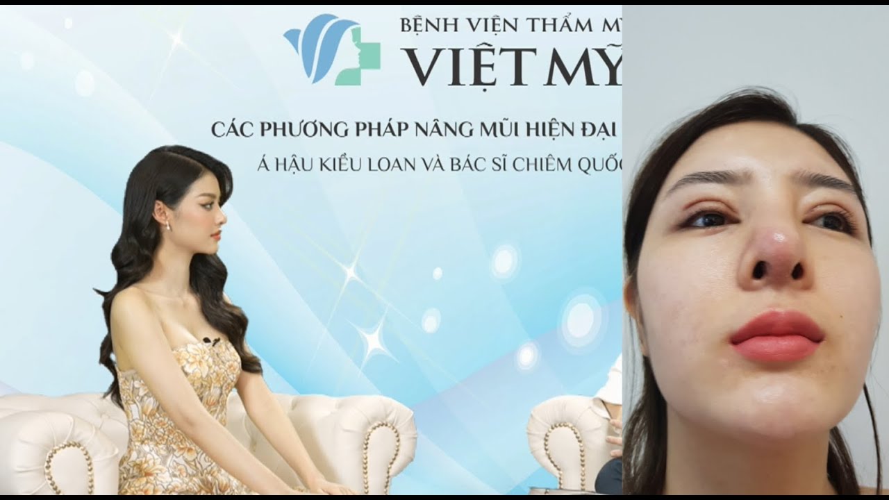 Nâng Mũi Tại Hàn Quốc Gặp Biến Chứng – Lời Khuyên Từ Bác Sĩ Chiêm Quốc Thái