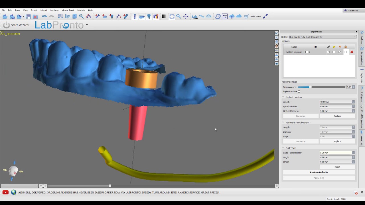 How to Reverse Engineer a Surgical Guide for Other Implant Systems in Blue Sky Plan