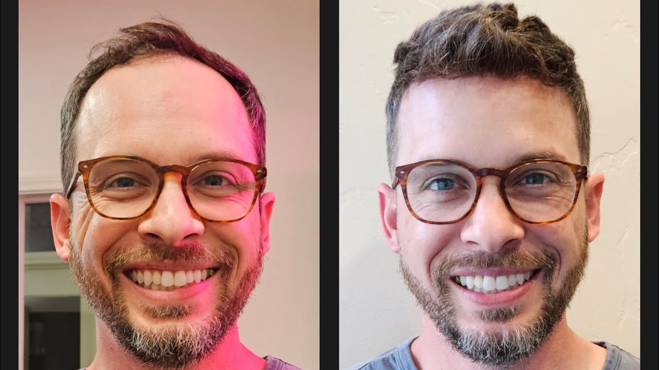 Bald Is Not A Hairstyle. Let’s talk about hair systems!