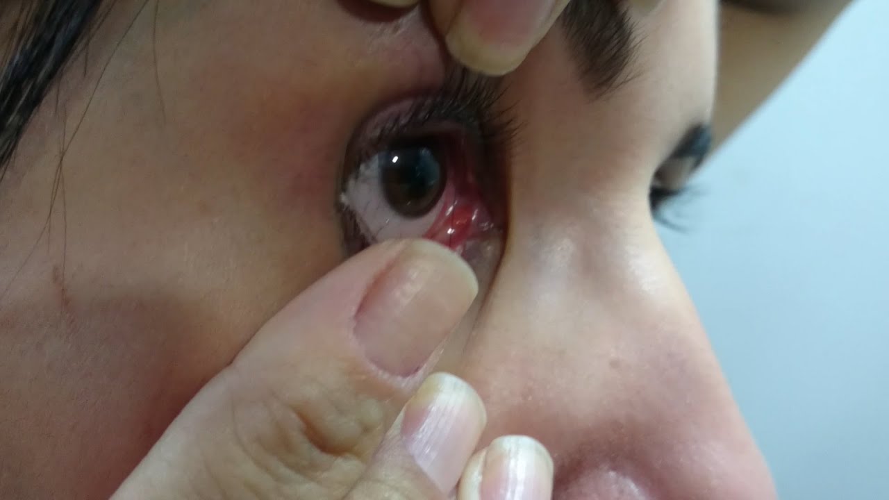A LENTE DE CONTATO SUMIU NO MEU OLHO