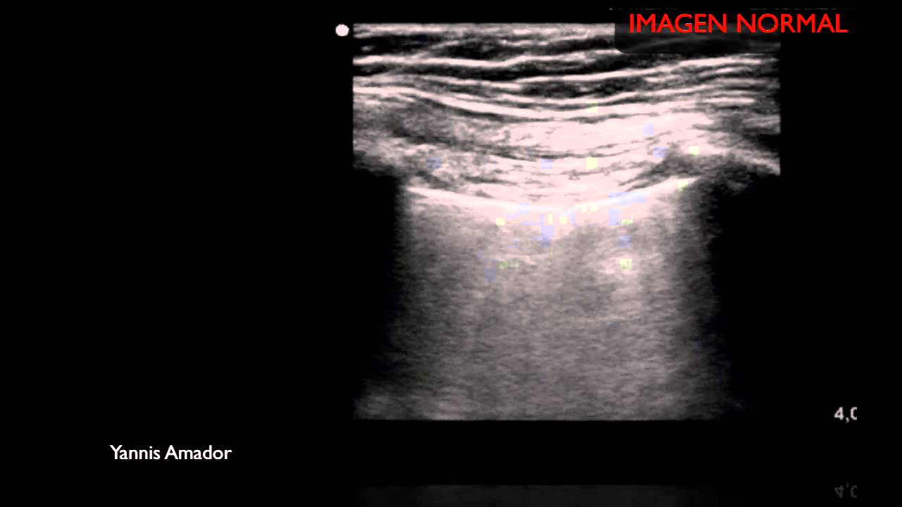 ECO PULMONAR EN NEUMOTORAX