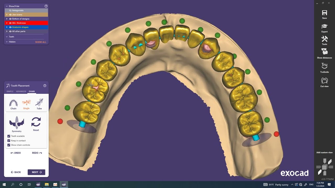 Exocad Video Tutorial To Design Gingiva
