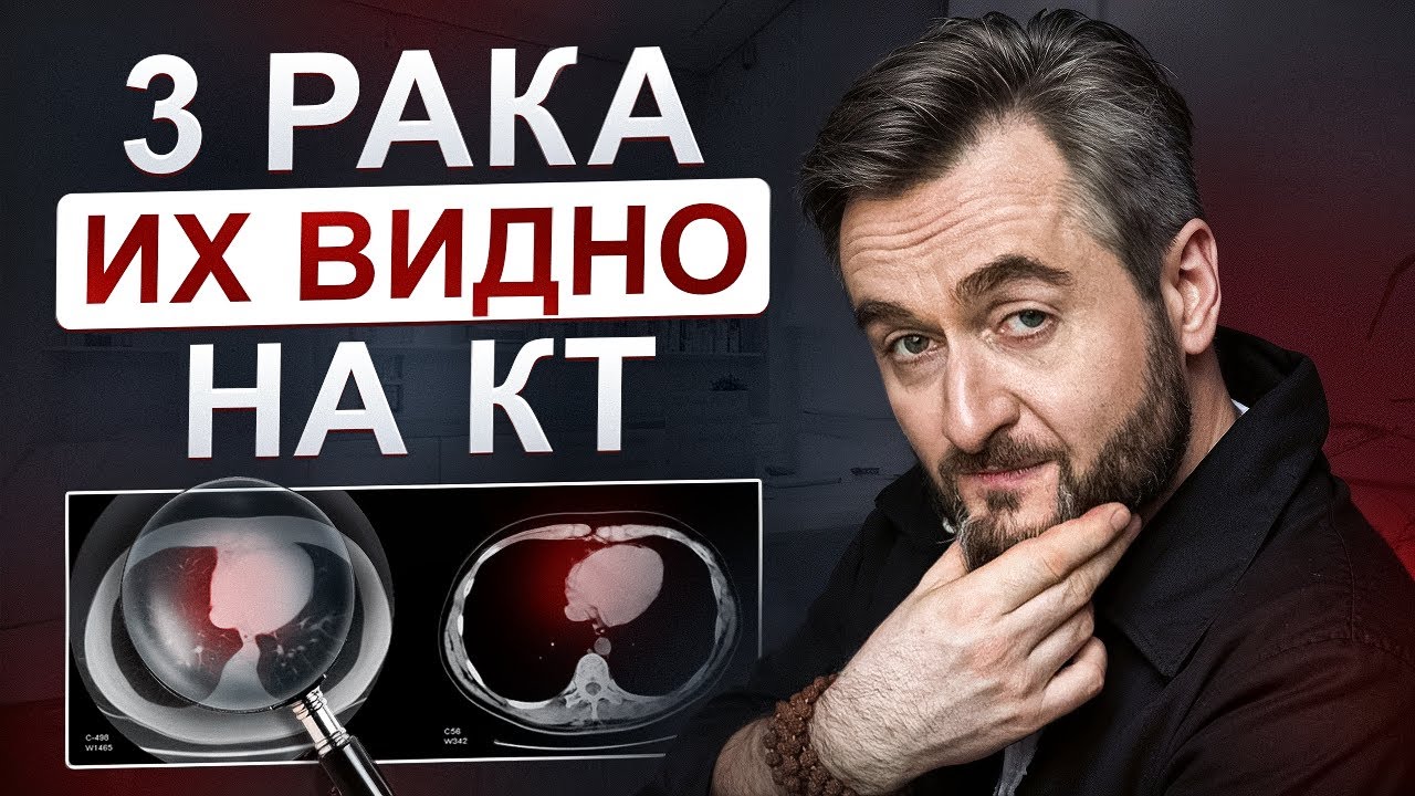 Их хорошо видно: коварные опухоли, которые КТ покажет даже на 1 стадии!