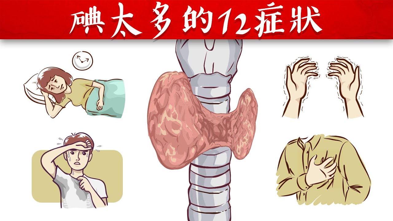 碘太多第一現象？共12症狀、需多少碘？橋本症自然療法,柏格醫生 Dr Berg