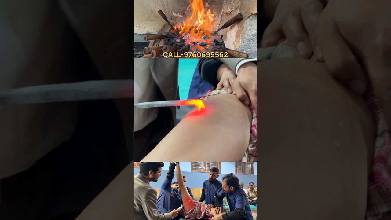 आयुर्वेदिक अग्निकर्म से AVN का दर्द और कंधे का दर्द गायब 🔥 | Dr Amit Prasad AVN SPINE & Joints