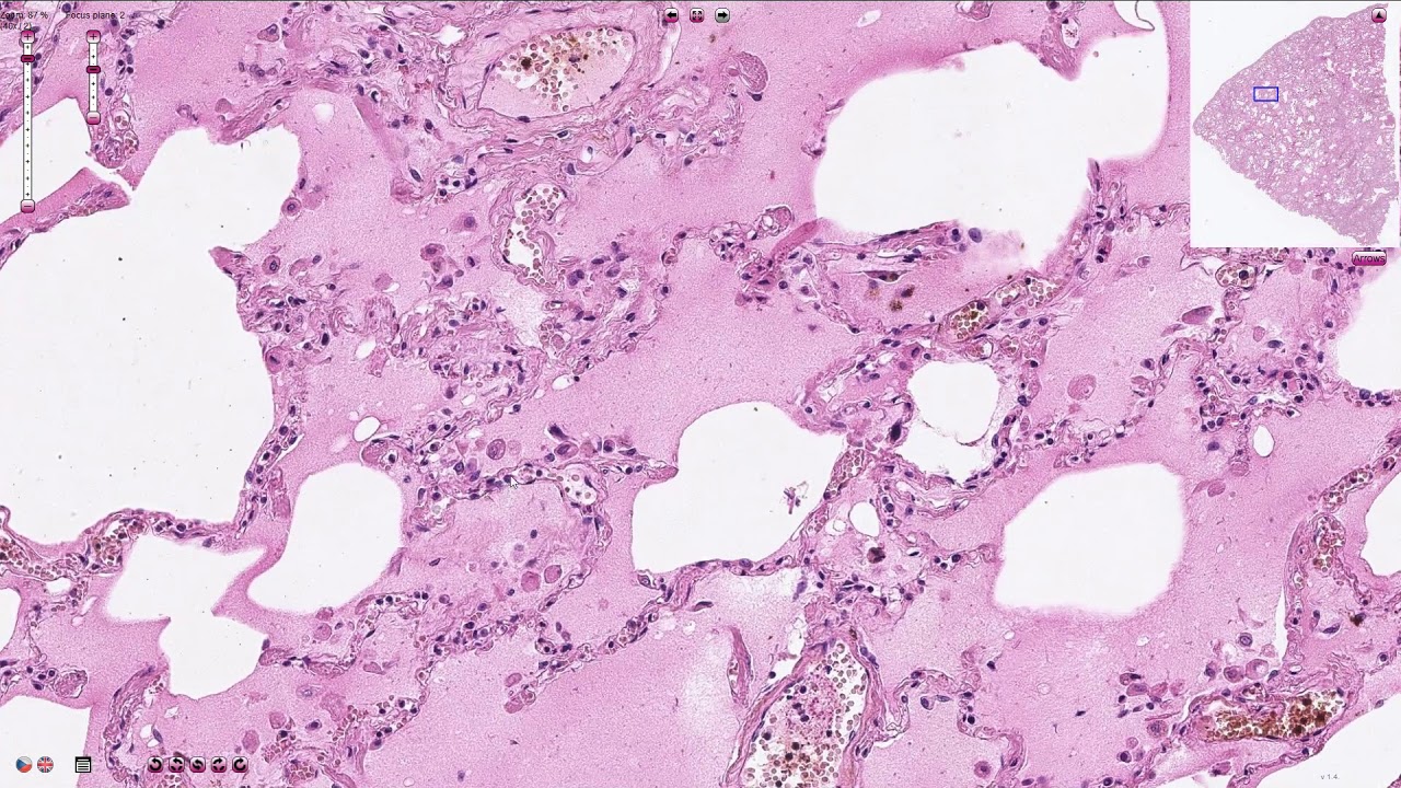 Pulmonary Edema - Histopathology