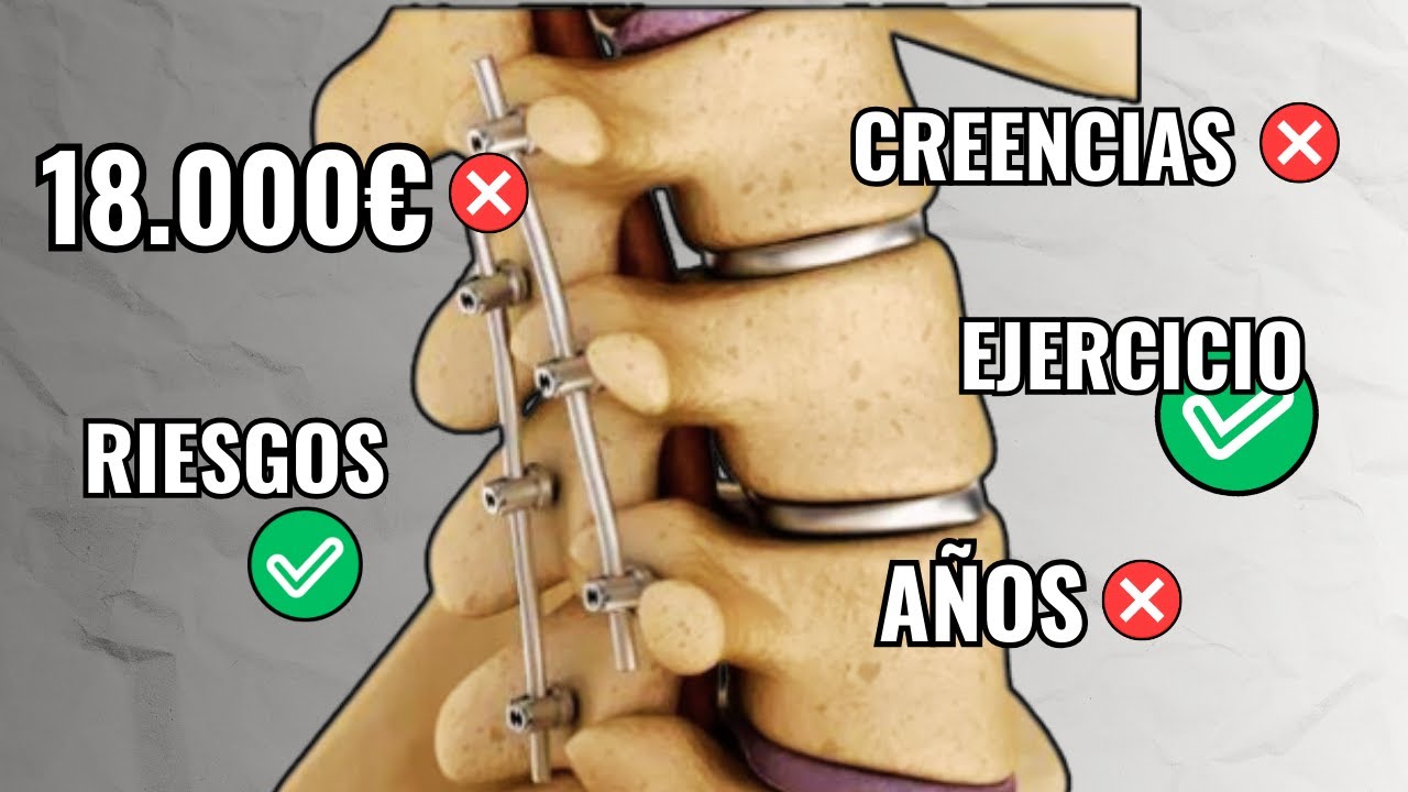 OPERACIÓN LUMBAR sin SECUELAS | Artrodesis, disectomía y foraminectomía